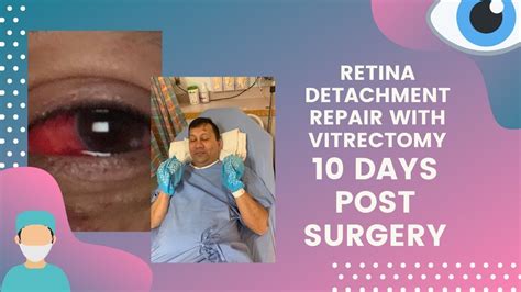 Finding Hope After Retinal Detachment Surgery: A Guide to a Positive Recovery